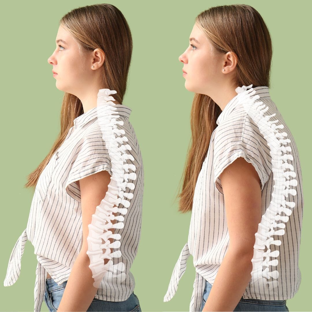 The Role of Alignmed Posture Garments in a Physiotherapy or Posture Rehab Treatment Plan